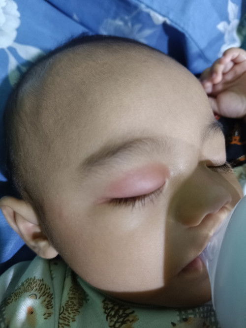 Mata bayi 6 bulan bengkak