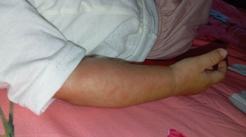 Biang keringat apa campak?