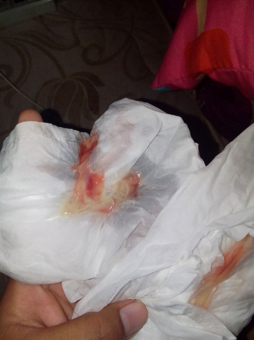 38+1wโดนกระตุ้นเมื่อวานวันนี้มีมูกเลือด