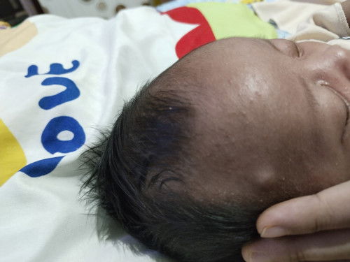Benjolan didahi bayi