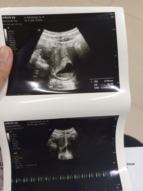 Pergerakan janin itu mulai trasa d usia brp wek bund q ud 9-10 week blm jg ngrasain pergerakan janin