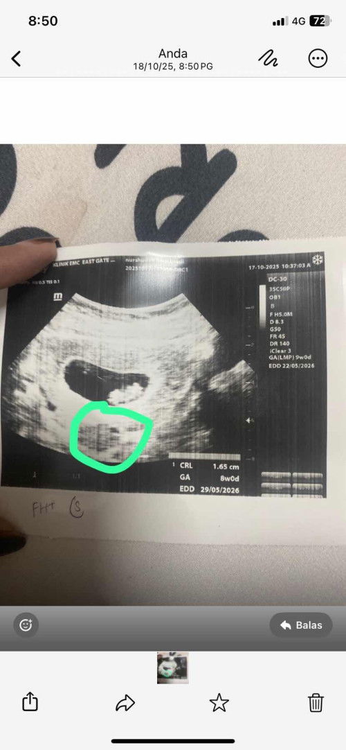 Fibroid masa mengandung
