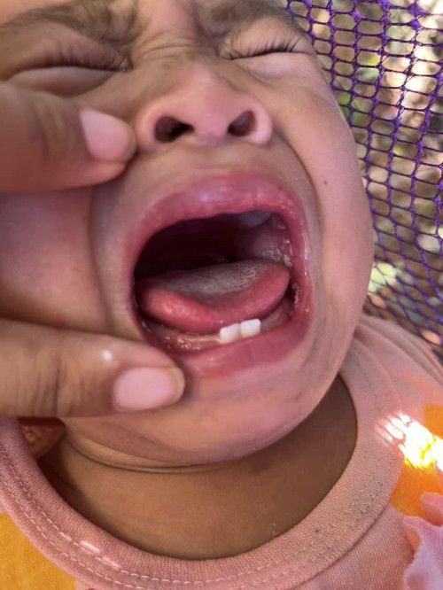 แบบนี้ใช่เชื้อราในช่องปากมั้ยค่ะแม่ๅ