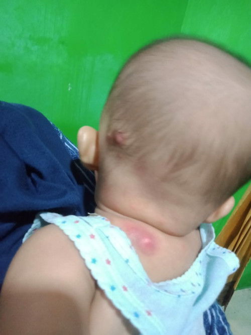 benjolan di punggung & kepala bayi