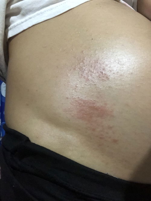 เป็นผื่นแดงคันแบบนี้ทำยังไงดีค่ะ