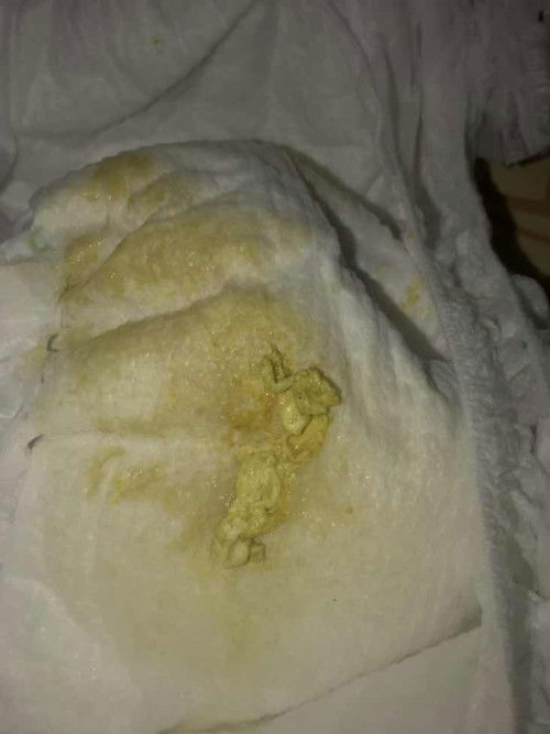 อึแบบนี้ผิดปกติไหมคะแม่ๆ