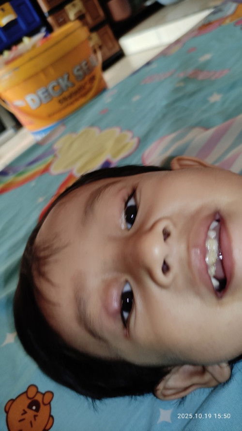 Benjolan di kelopak mata anak