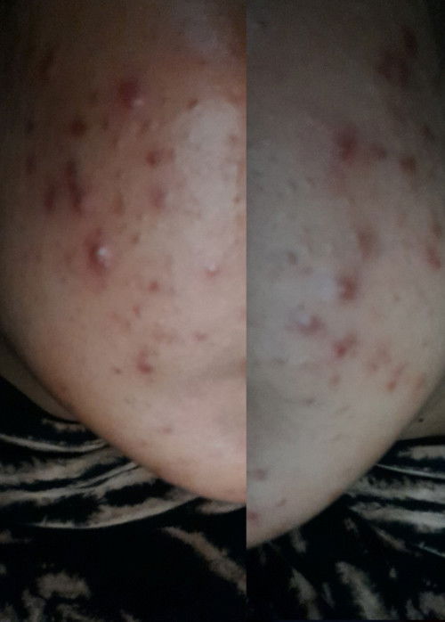 Bun ada yg tau obat jerawat saat hamil, soalnya coba tritment, skincare acne, obat totol. hasil zonk