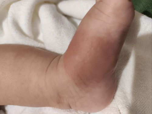 What do you usually do to LO's bug bite?