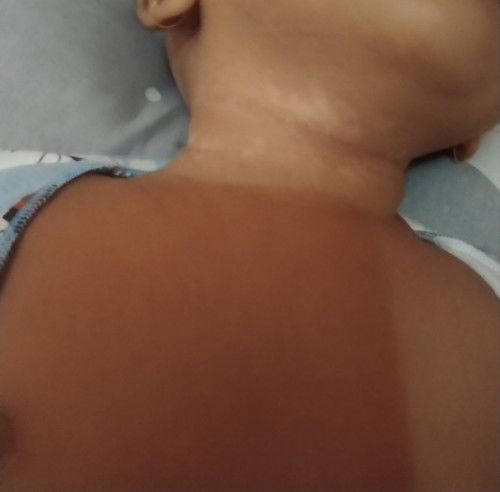 Bintik Putih dileher bayi