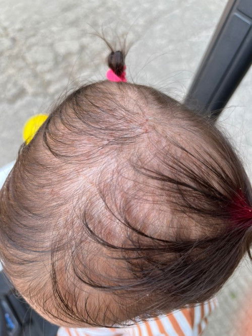 Kepala kayak ketombe usia 17 bulan