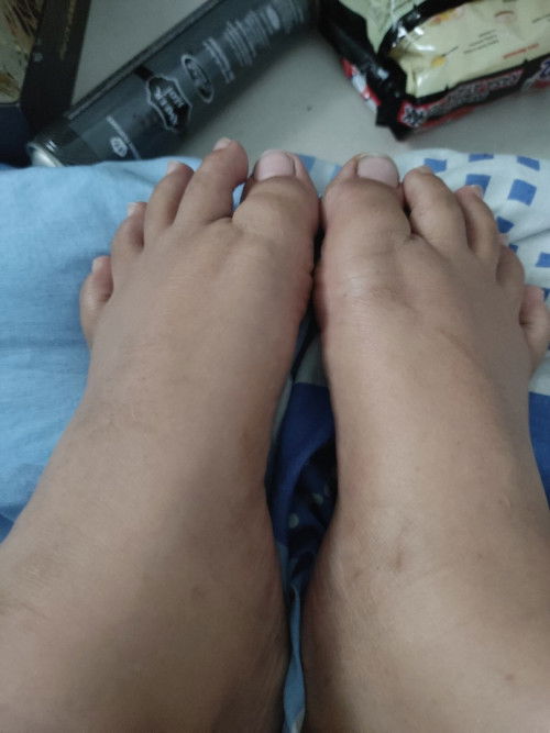 Kaki bengkak atau tidak