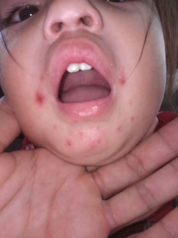 Hello po mga mi gusto ko lang itAnong kung ano po ba ito kinakamot ng kinakamot ng anak ko