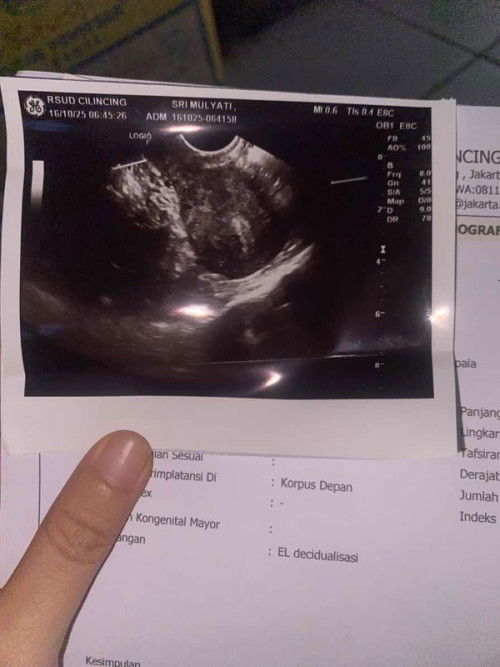 Pendarahan 8week