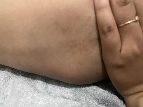 Ada yg tau bun prodak yg dapat menghilangkan ruam pada area bokong bayi
