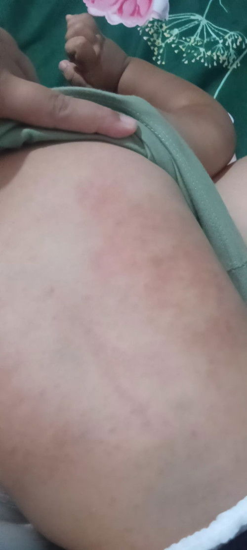 Merah merah di punggung