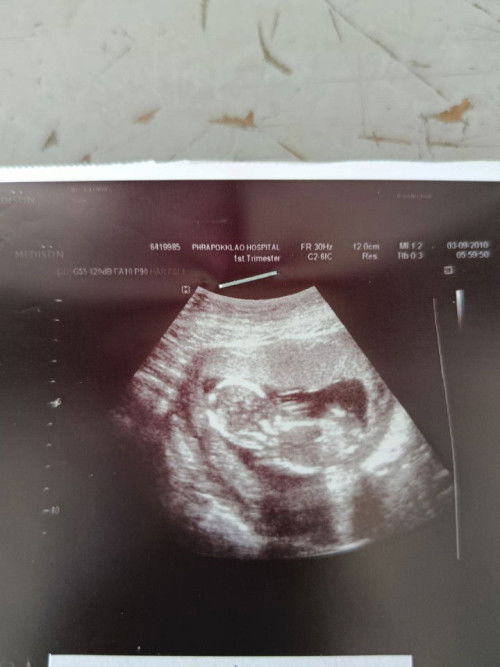 13สัปดาห์5วัน นน53.6 ผลนีฟออกแล้ว ความเสี่ยงต่ำ ได้ลูกสาวค่ะ ความยาวลูกสาวอยู่ที่7.41เซน