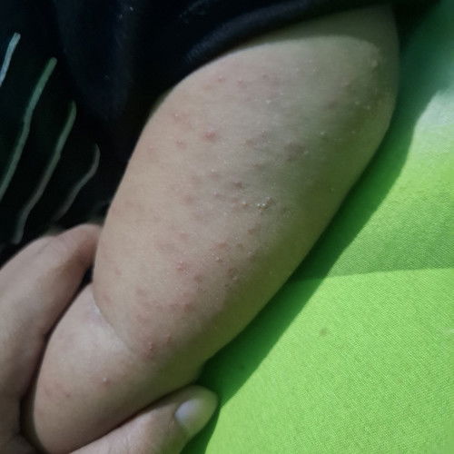 musim panas banyak bruntusan apa anak anak bunda ada yg sama?