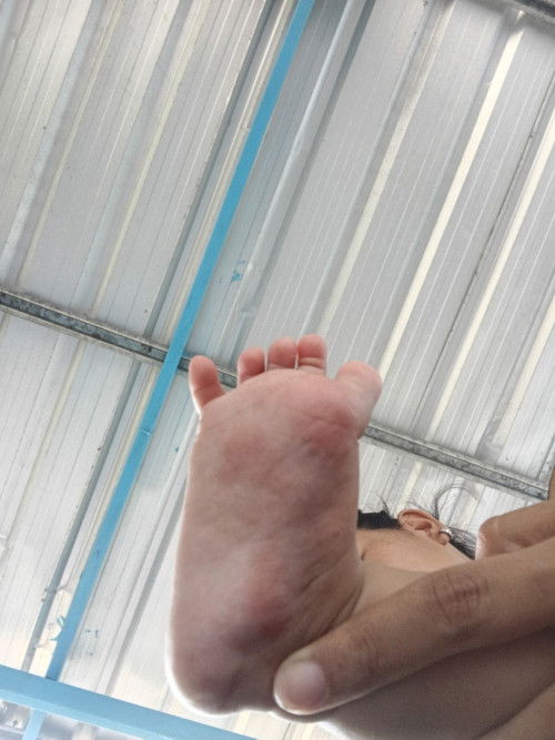เท้าลูกน้อยเป็นแบบนี้ควรทำยังใงคะ