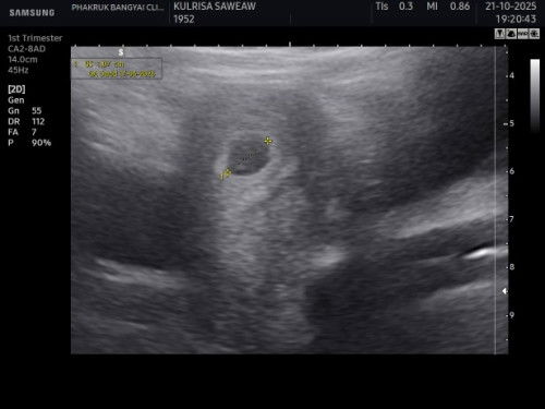 อายุครรภ์7w4วัน