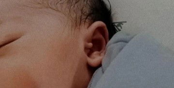 Tanda lahir di telinga