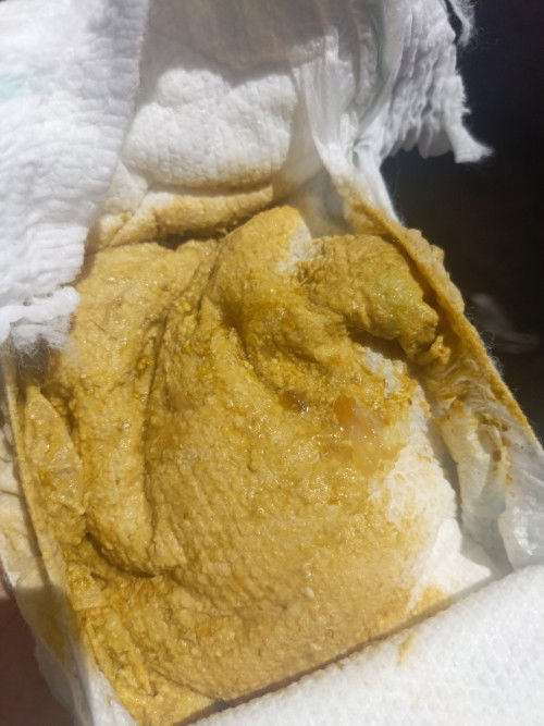 น้องถ่ายแบบที่ทุกวัน3ครั้งต่อ1วันหลังกินนมเสร็ดผิดปกติไหมค่ะ