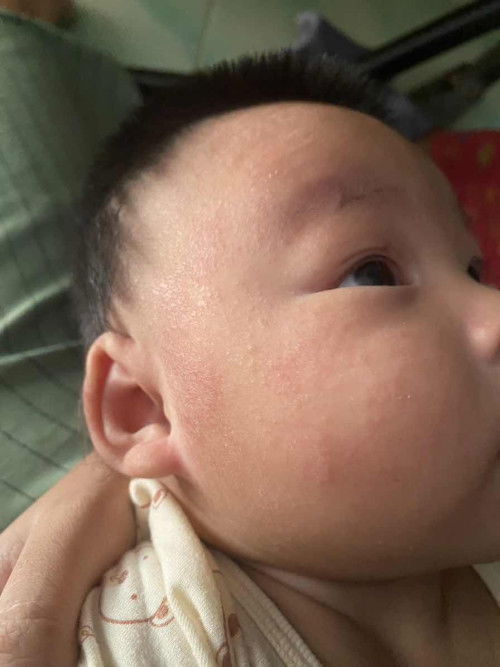 ผื่นแบบนี้เกิดจากอะไรคะ