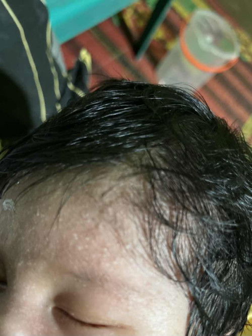 Bintik bintik berair di kulit bayi