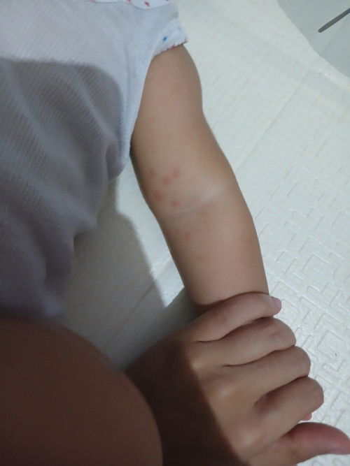 Bun babynya ada yg pernah gini gak yaa cuma lengan aja, dikasih salep apa ya