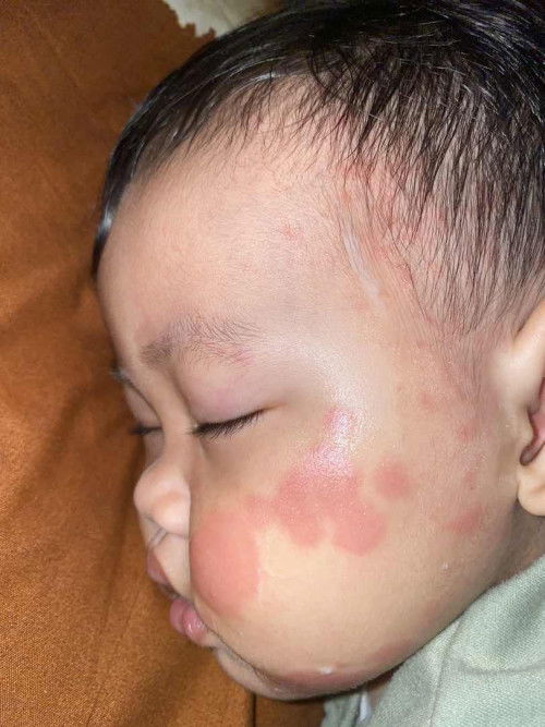 merah” dimuka & badan bayi