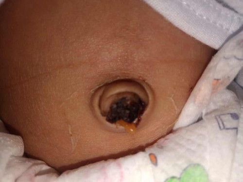 Natanggal pusod ni baby pero may onting laman na nakausli pa normal ba to?