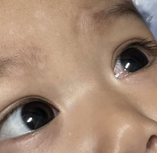 ตื่นเช้ามาลูกตาแดง คนที่บ้านบอกน่าจะนิ้วหรือไม่ก็ของเล่นที่น้องเล่น แต่น้องเล่นแค่ยางกัดค่ะ