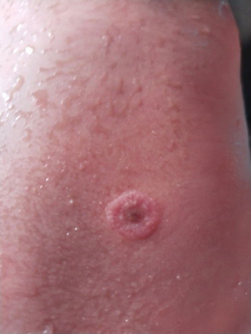 Kulit punggung bayi melepuh