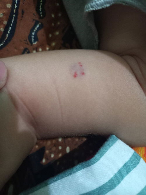 Bintik merah di lengan
