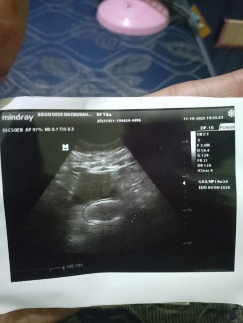 bun normal ga ya USG 6minggu baru keliatan penebalan dinding rahim? ovt banget ini bun
