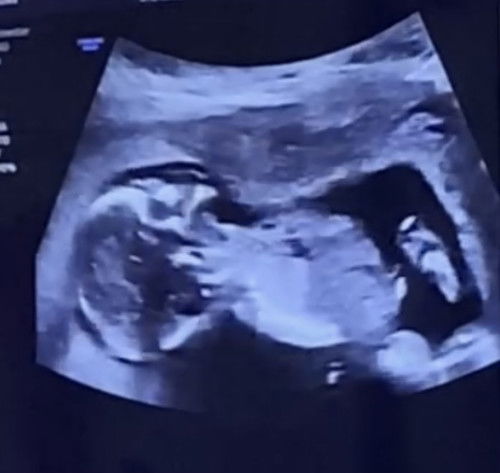 Boy or girl? 14weeks scan