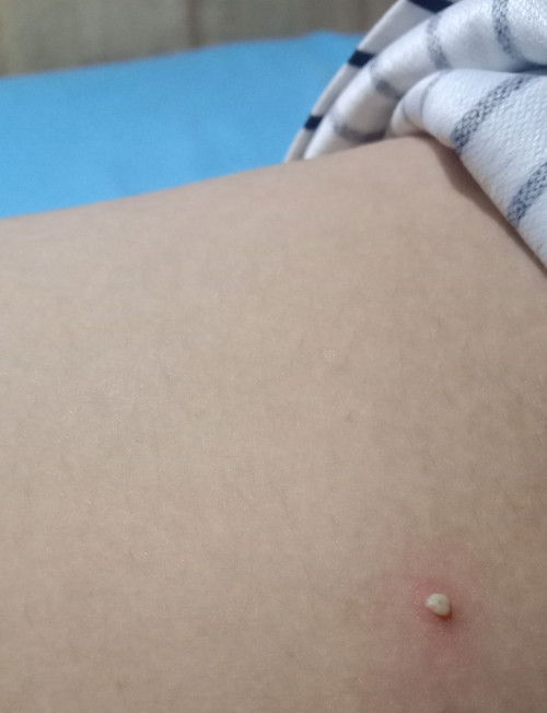 Pigsa paano maiiwasan