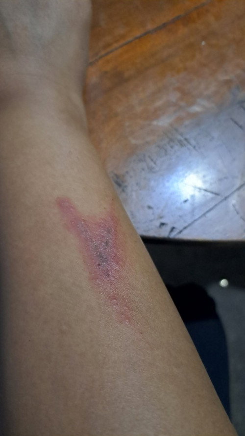 Dermatitis atopik
