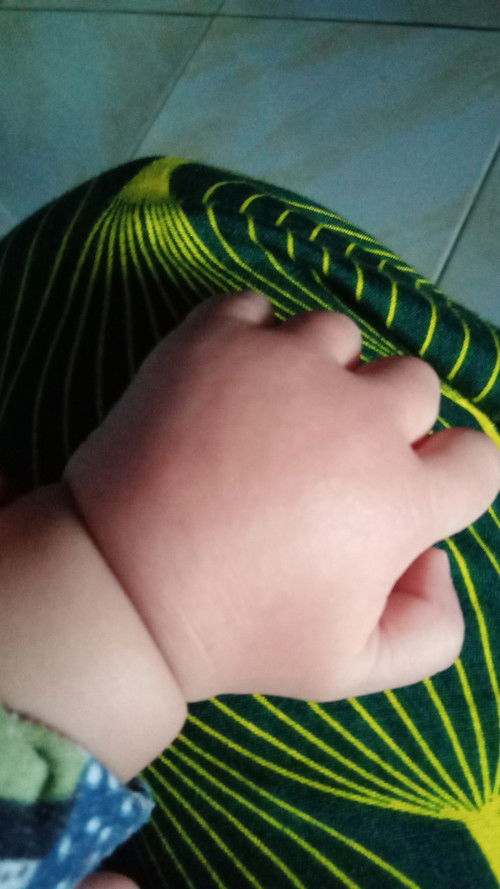 Tangan anakku bengkak gak tau d gigit apa