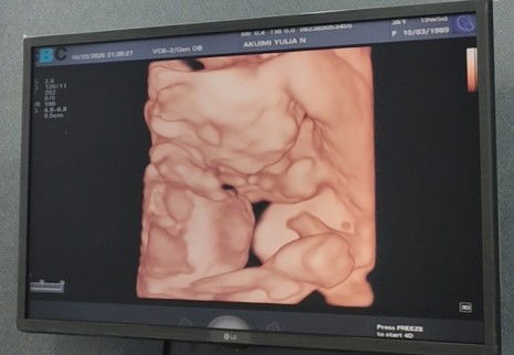 Photo hasil UsG 19w5d