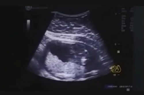 อัลตร้าซาวด์ดูเพศ