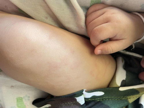 แบบนี้คือแพ้อะไรค่ะ