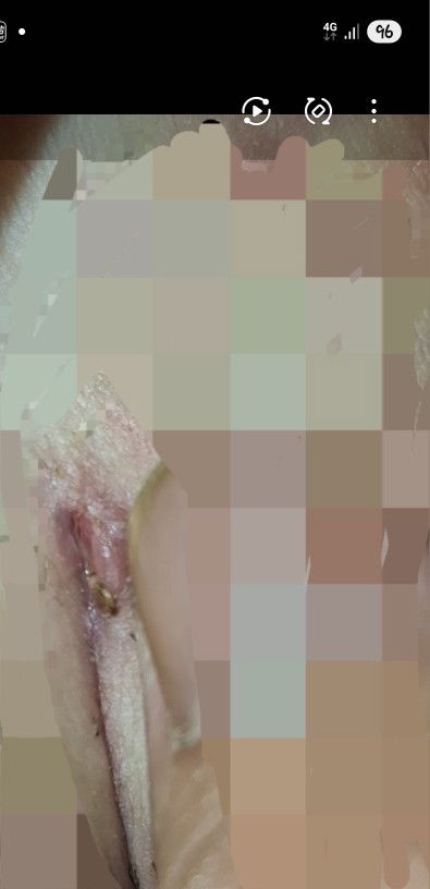 Jahitan czer terbuka