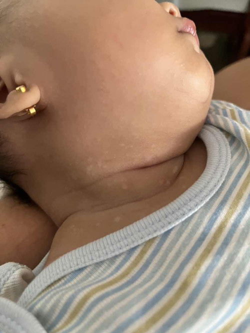 Rashes sa leeg ni baby 🥲
