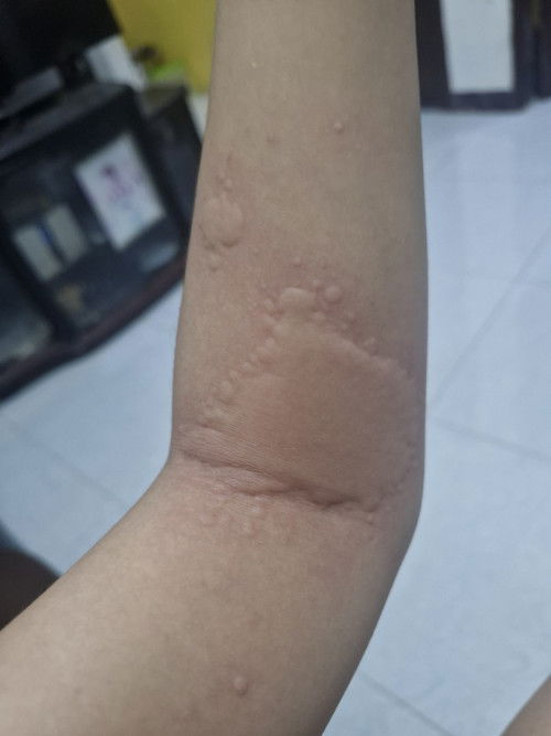 Bun obat gatal biduran yang aman untuk ibu hamil apa yah?