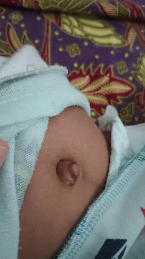 Pusar menonjol keluar