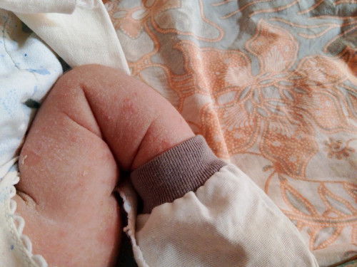 Bunda bunda apa ad anak2 bunda yg mengalami sama anak saya, badan dan tanganya sprt gmbr yg ku posti