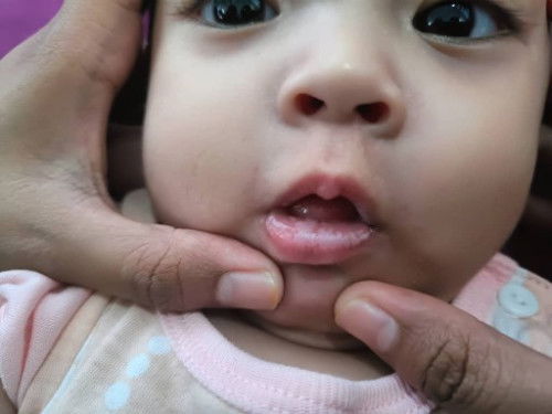 salam smua , nak tnya ni kulat susu ke ? sya baby dia prnh kena mcm ni pls bgtau apa sya prlu buat .