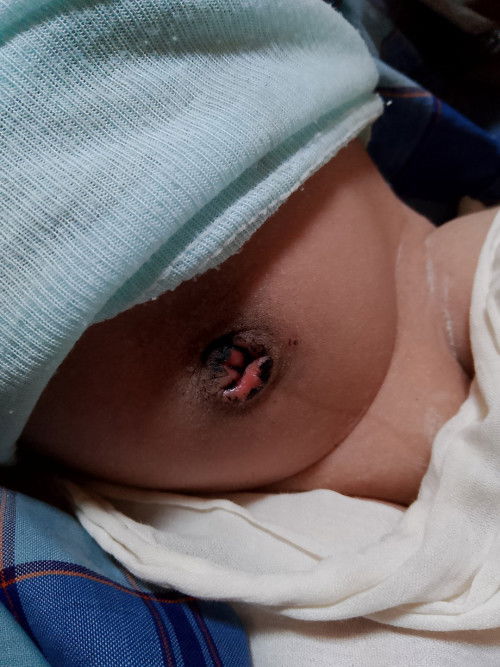 Bun tips ny agar pusat anak kering dan sembuh, udah 20 hri tp blm juga kering lukanya, 🙏🙏