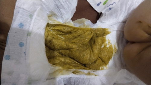 5months si baby normal lang ba yellow green na basa at may maamoy Ang poops formula milk nya.